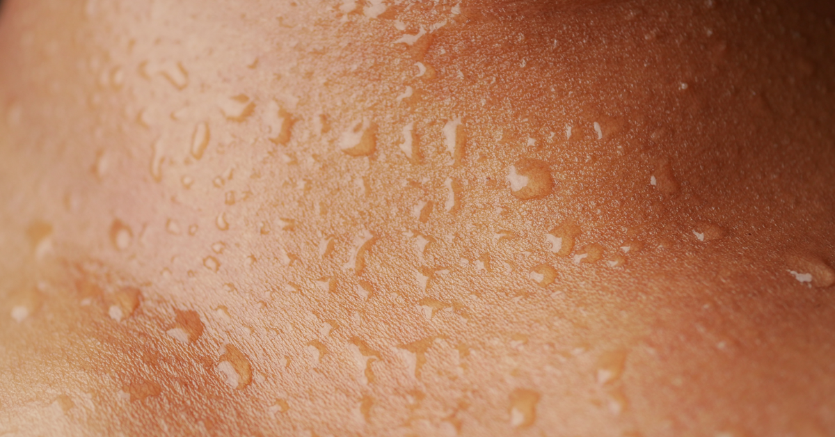 Close-up of beads of sweat on skin, illustrating hyperhidrosis (excessive sweating)
